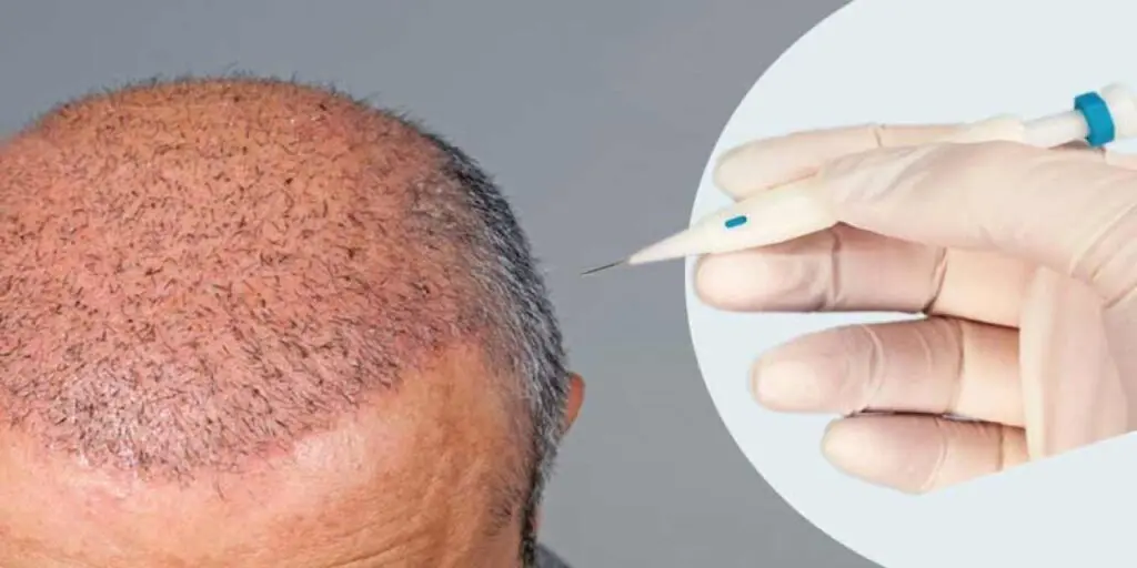 تجربتي في زراعة الشعر في دبي تجربتي في زراعة الشعر في دبي