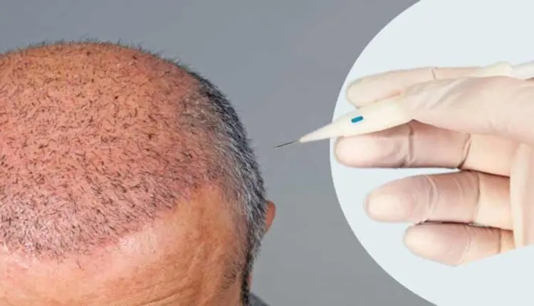تجربتي في زراعة الشعر في دبي