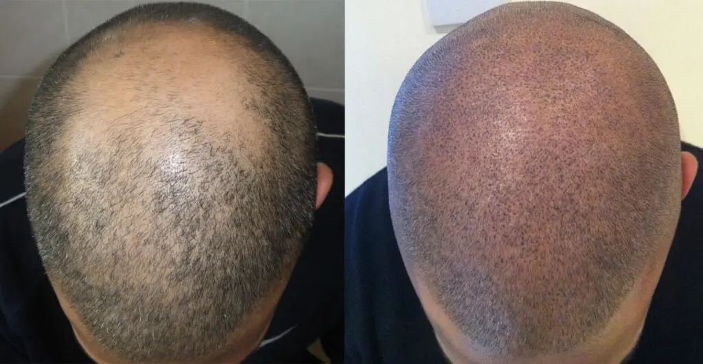زراعة الشعر في السعودية 