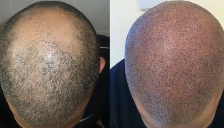 تجربتي في زراعة الشعر في دبي