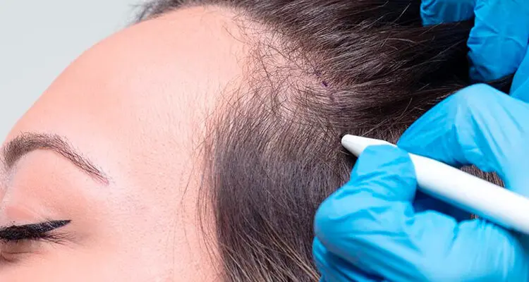 عملية زراعة الشعر في سلطنة عمان