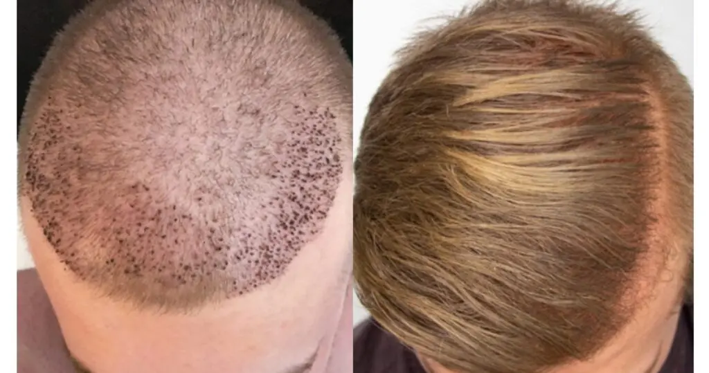 تكلفة زراعة الشعر في الكويت