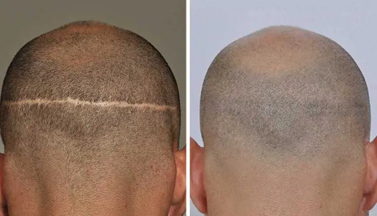 أفضل أماكن زراعة الشعر في السعودية 2023 ولماذا هي الأفضل؟