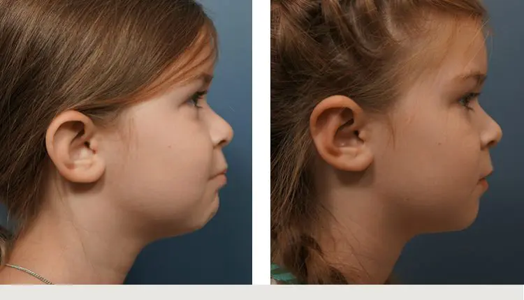 تجربتي مع عملية تجميل الأذن 
